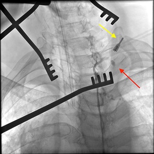 TD localization in operative field relative to a microvascular clamp